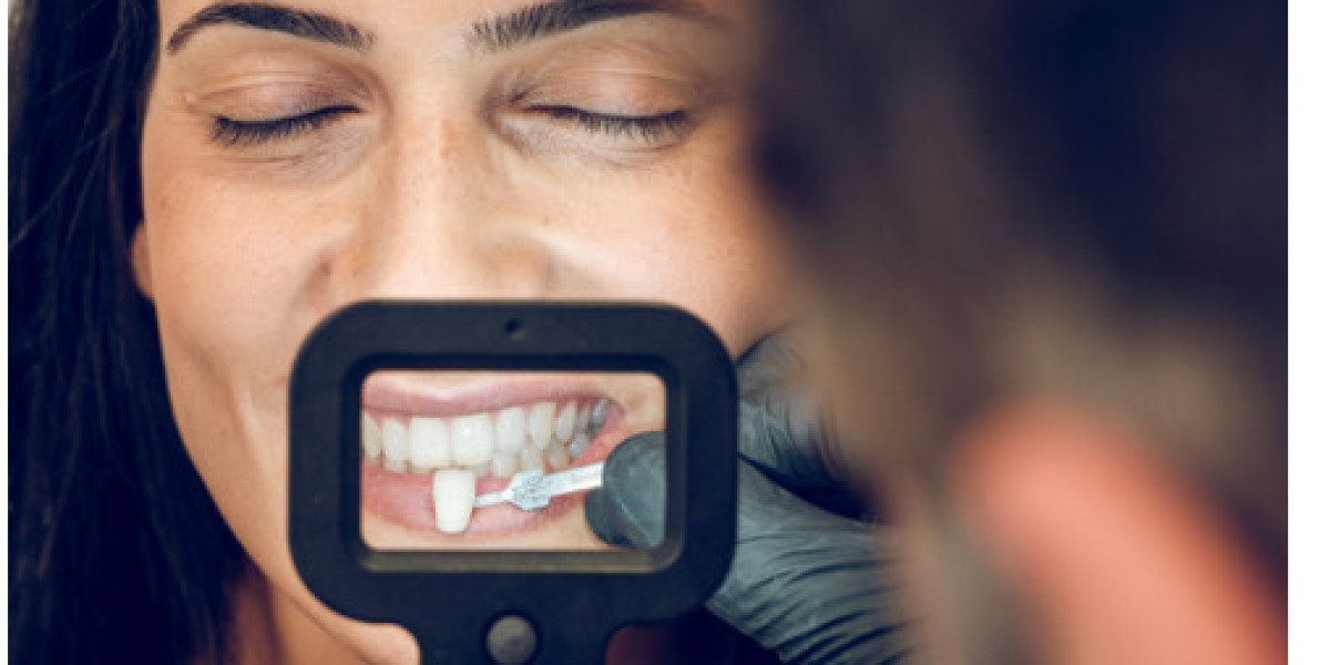 Brighten  Smile with Professional Teeth Whitening in Indiranagar – Book Your Appointment Today!