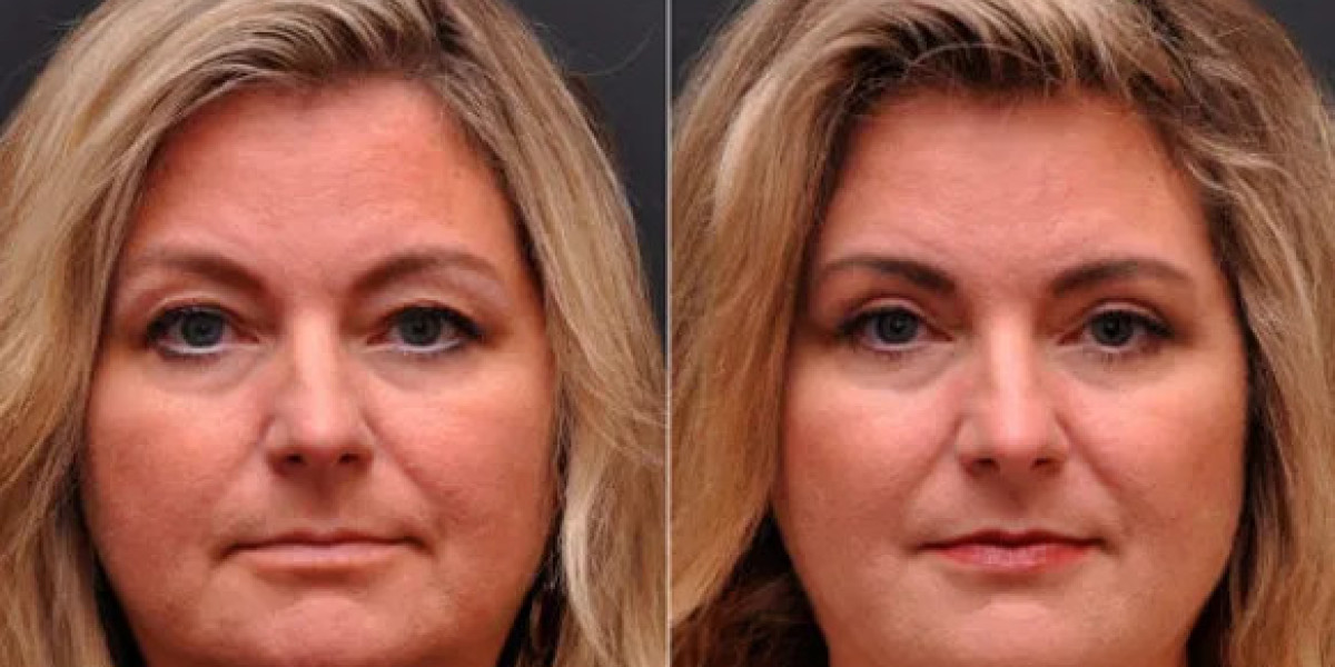 Blepharoplasty In Bangalore