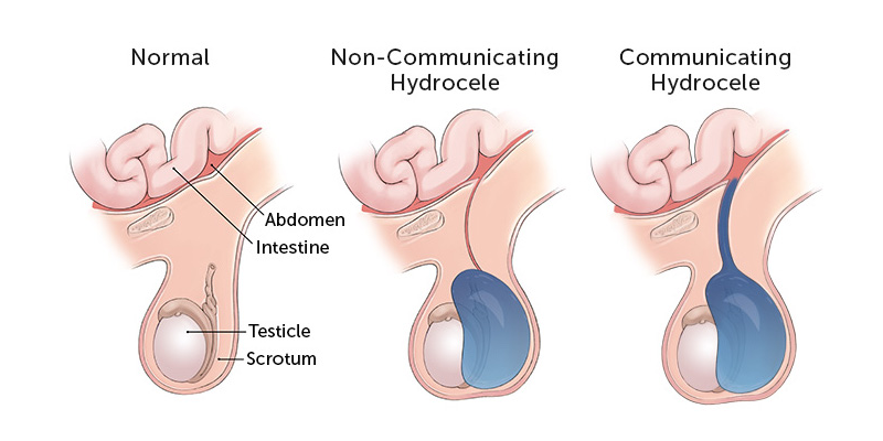 Natural Remedies for Hydrocele Let’s Start with Detail