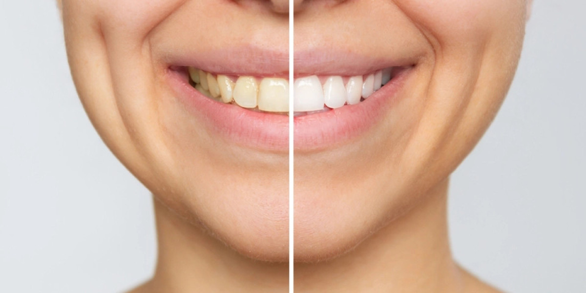 How Teeth Whitening Cost Changes With Each Method