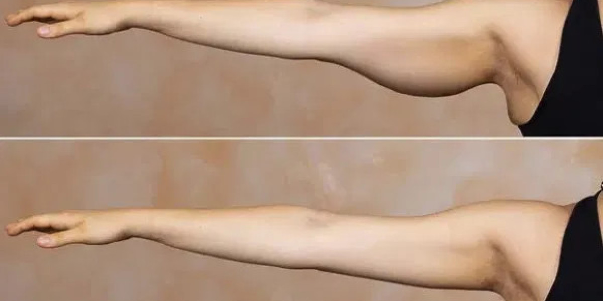 Arm Lift In Bangalore