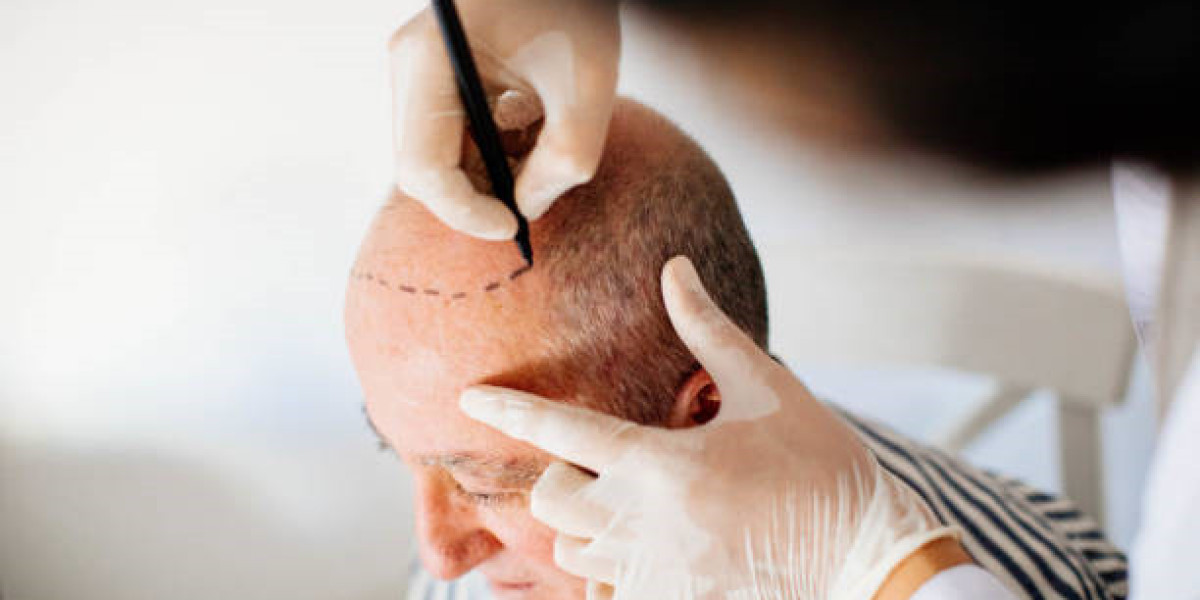تقنيات زراعة الشعر الحديثة وأحدث التطورات العالمية