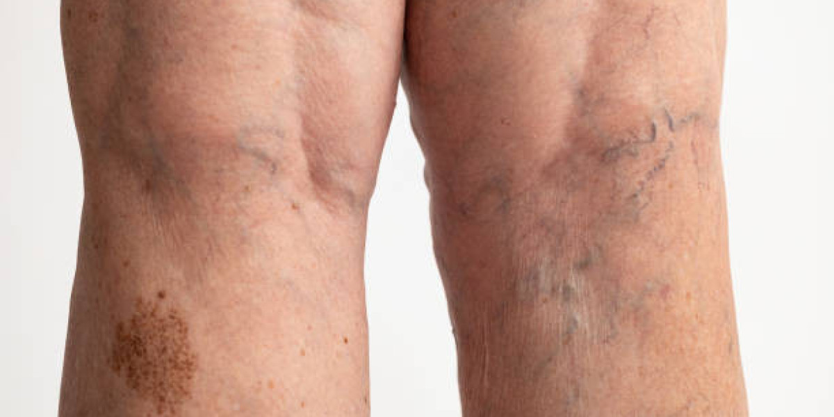 What Conditions Can Vascular Surgery in Riyadh Treat Effectively