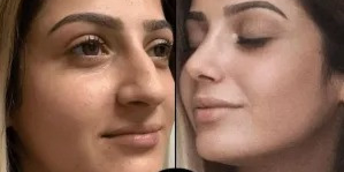 Personalized PRP Treatments in Dubai for Every Skin Type