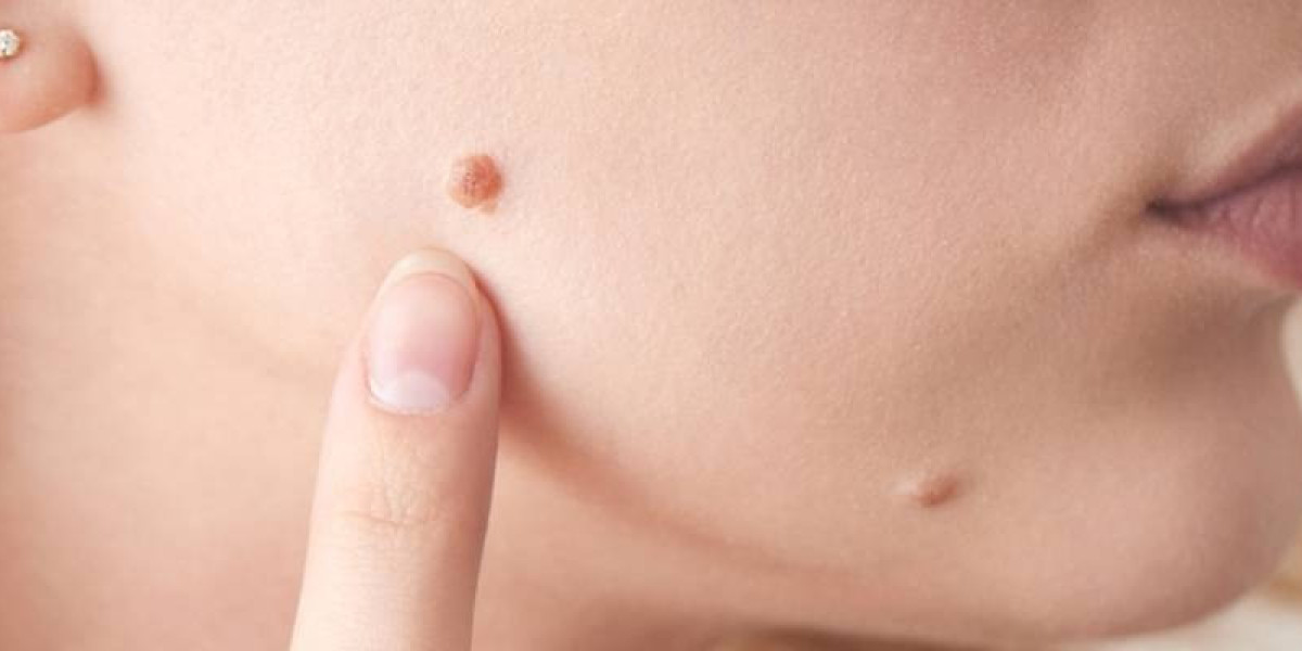 How to Get Rid of Skin Warts Safely