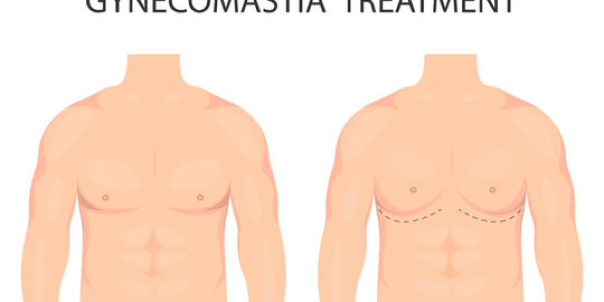 Recovery Time After Gynecomastia Surgery in Islamabad