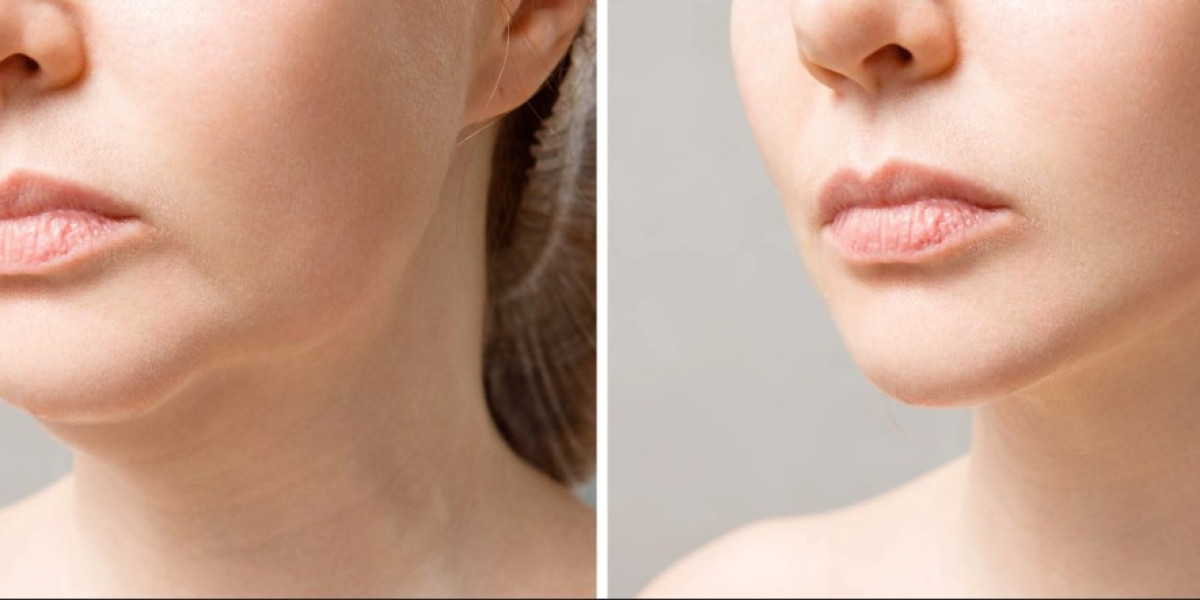 Double Chin Liposuction in Islamabad – Complete Guide