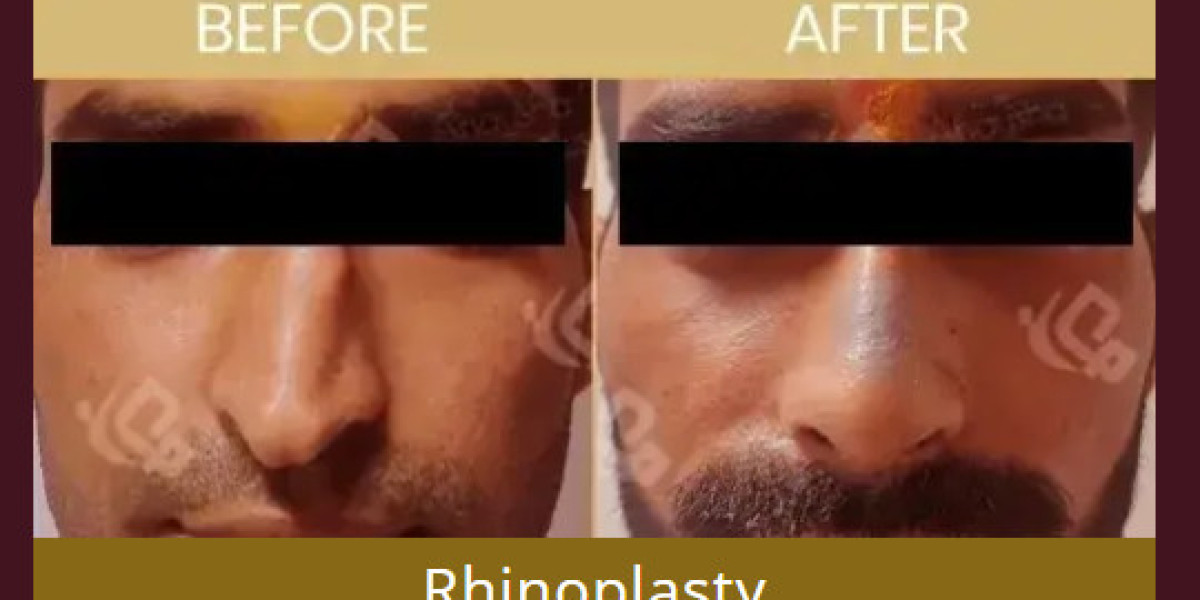"Rhinoplasty Surgery in Delhi |  Rhinoplasty Cost in Delhi"