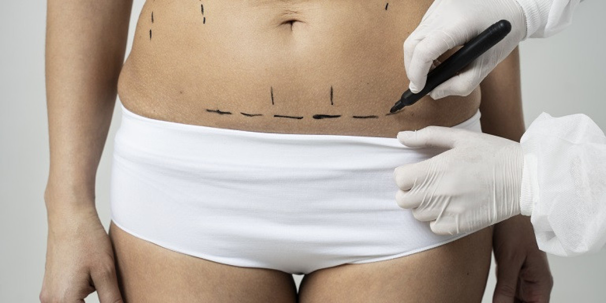 Laser Liposuction in Riyadh: Expert Surgeons Share Their Tips
