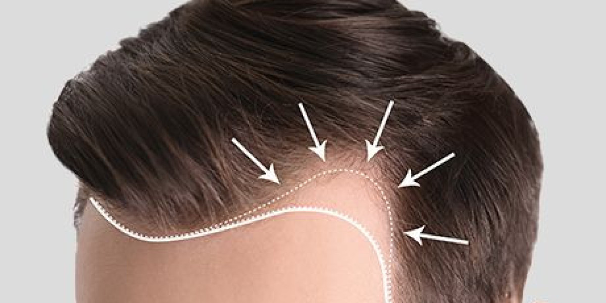 Hair Transplant Recovery Tips in Riyadh