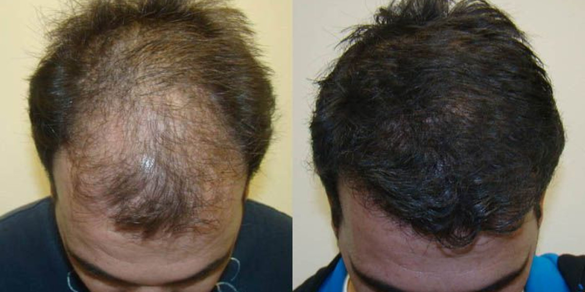 How Many Sessions Are Required for FUE Hair Transplant?