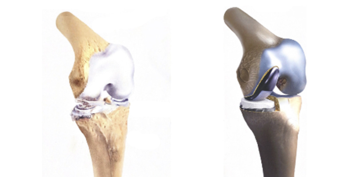 Partial Knee Replacement Perth: Is It the Right Option for You?