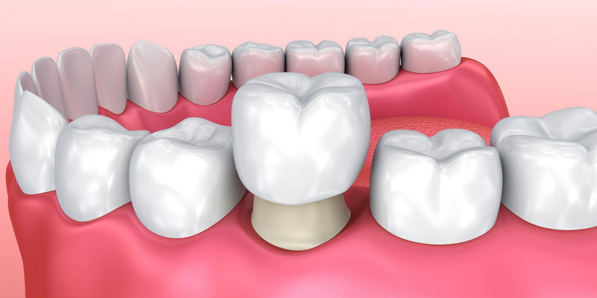 Cost of Dental Crowns in Islamabad: A Complete Guide