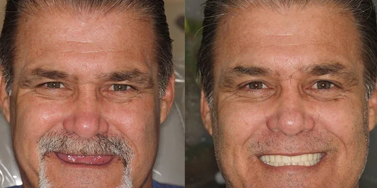 Why Dental Implant in Islamabad Is the Most Reliable Tooth Replacement