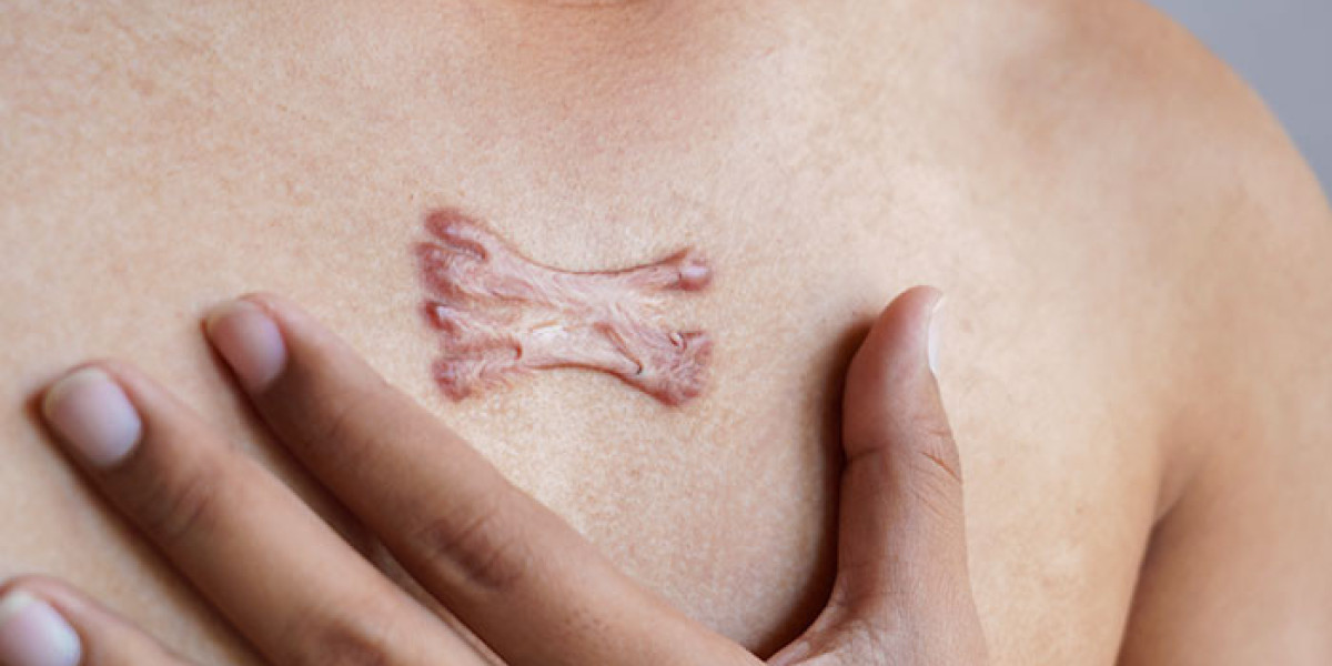How Long Does It Take to See Results from Keloid Treatment?