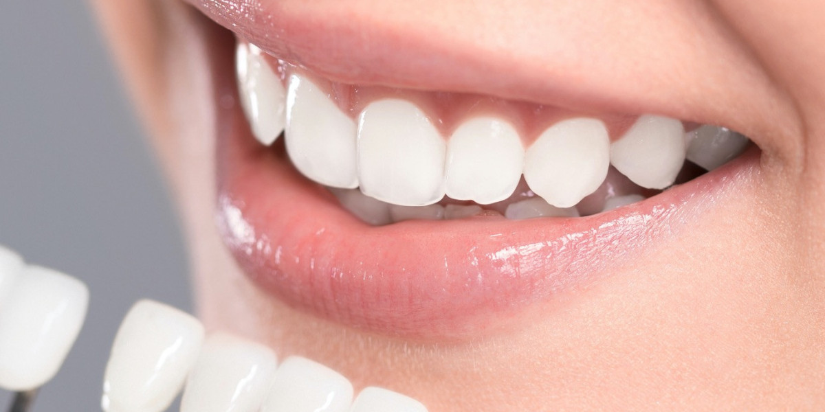 Expert Guide to Dental Veneers Procedures in Islamabad