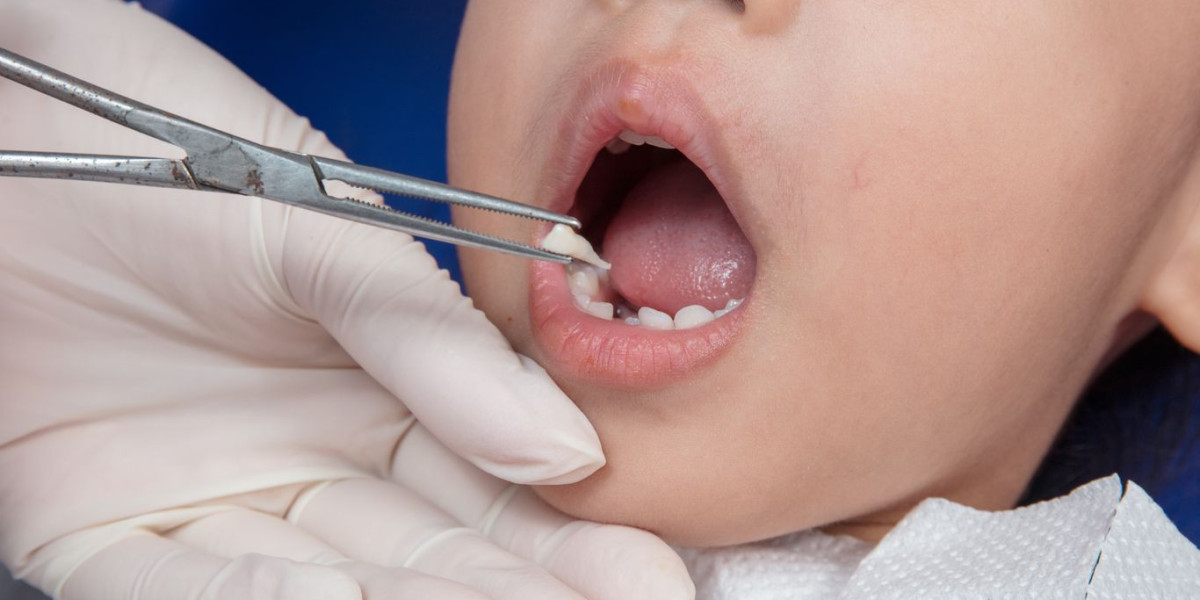 Tooth Extraction Cost Breakdown: Fees and Charges