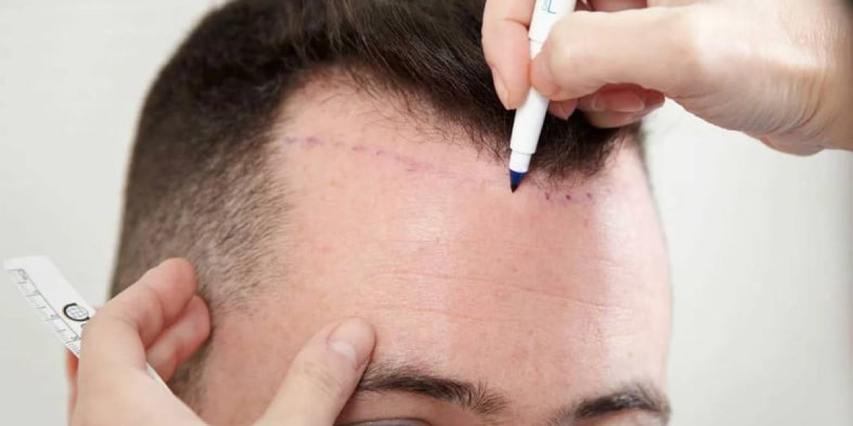 Hair Transplant for Bald Spots Restoring Confidence Naturally