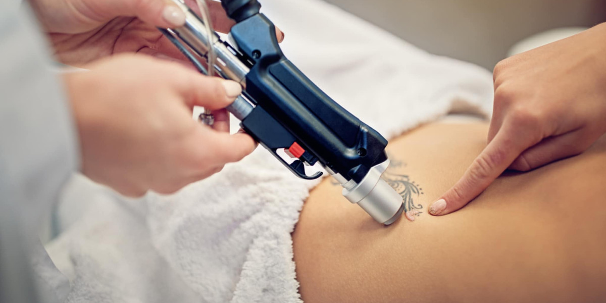 Laser Tattoo Removal for Dark Skin: What You Need to Know