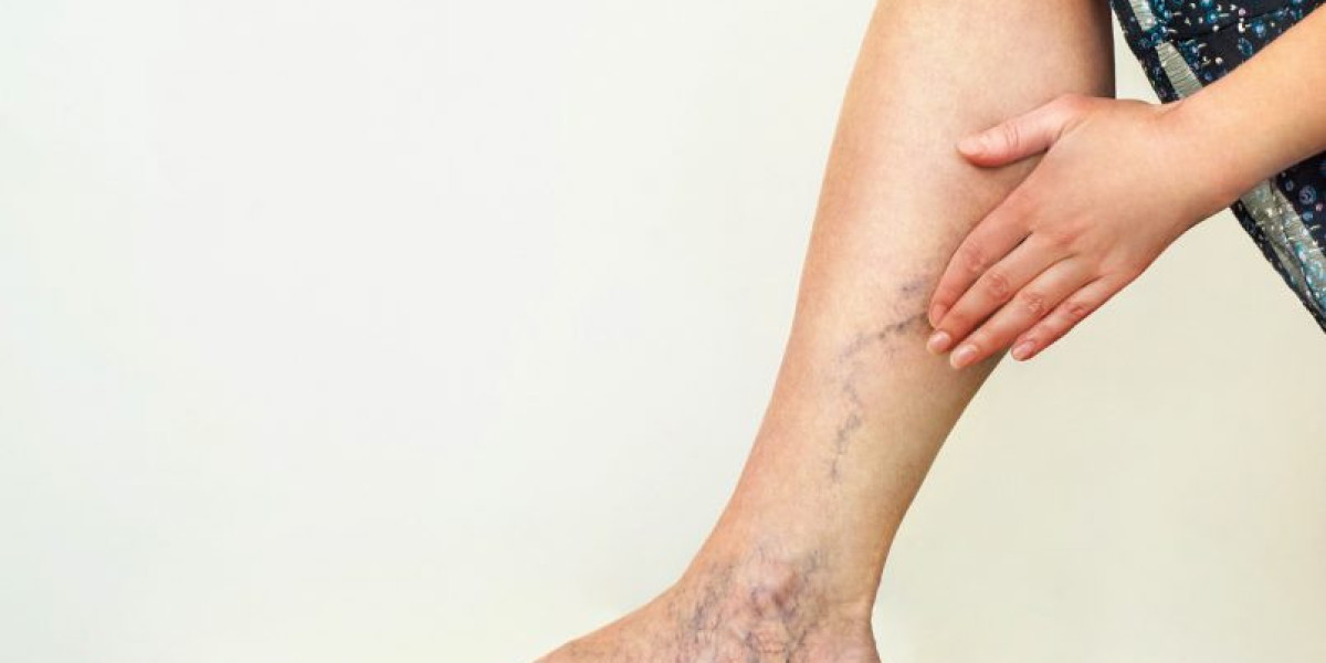 Micro-Sclerotherapy: Targeting Smaller Spider Veins