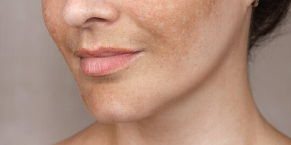 Is Melasma Treatment in Islamabad Truly Effective?