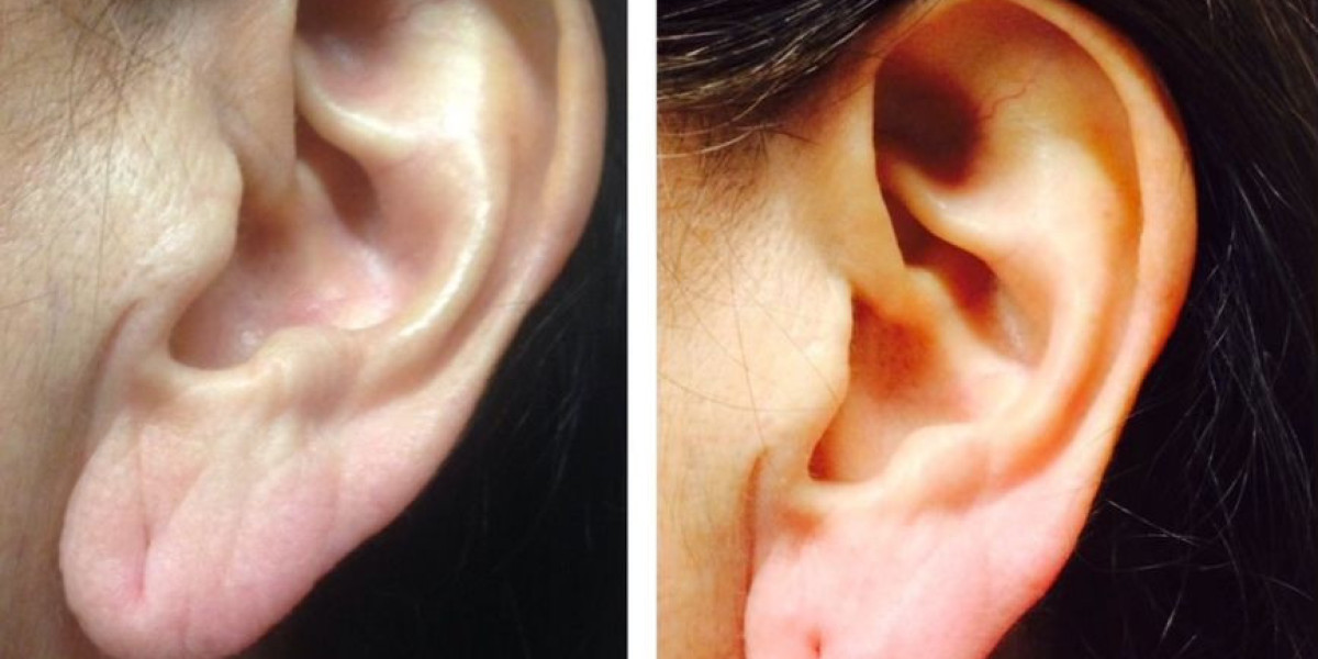 Ear Reshaping Experts Near Me Riyadh