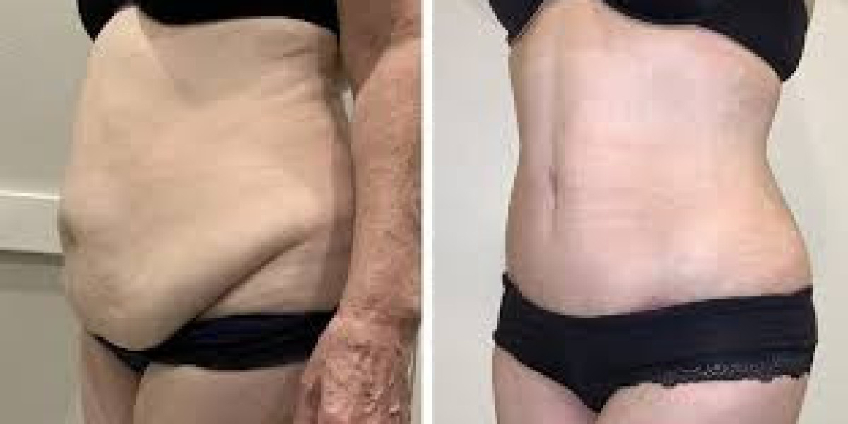 What Are the Side Effects of Liposuction in Islamabad?