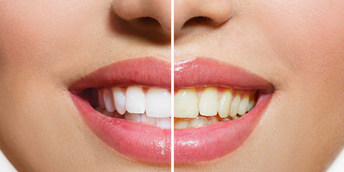 Discover the Secret to a Radiant Smile with Teeth Whitening