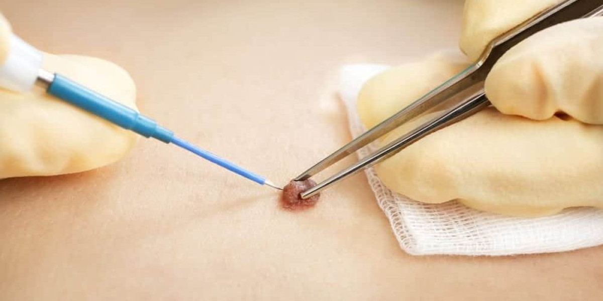 How Much Should You Expect to Pay for Wart Removal?