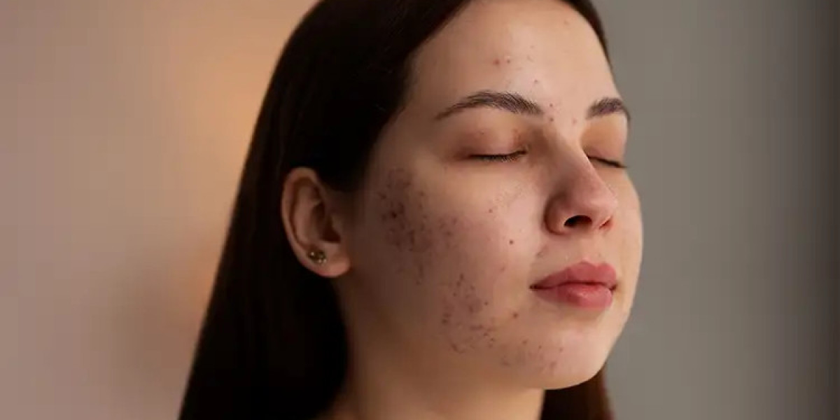 How To Remove Acne Scars Permanently, According to Experts - Best Dermatologist in Ludhiana