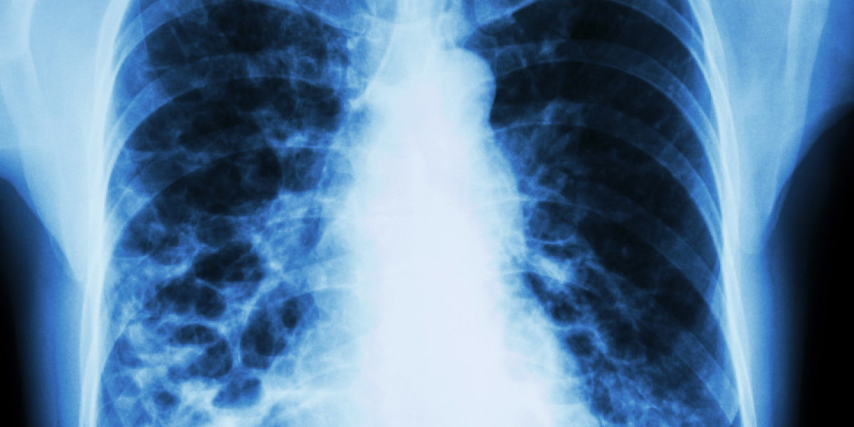 Bronchiectasis Epidemiology Forecast: Prevalence, Trends & Outlook 2034