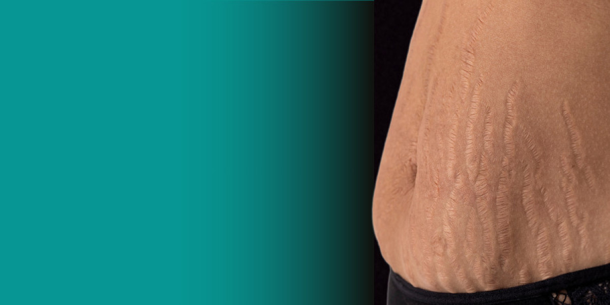 How Laser Stretch Marks Treatment Can Improve Skin Appearance