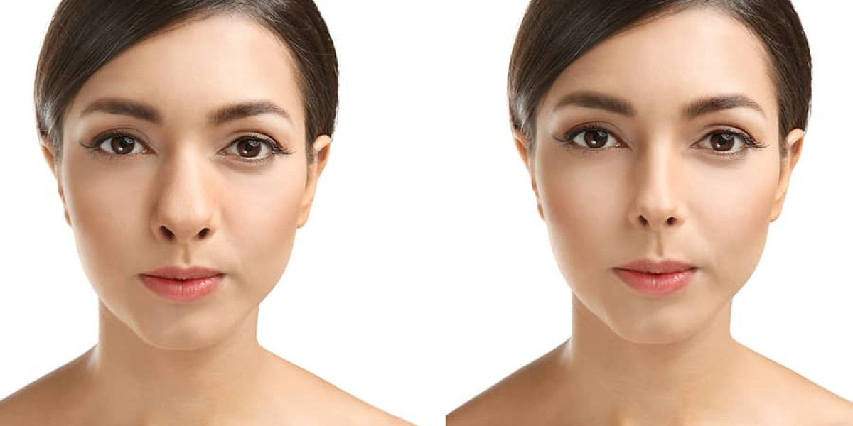 Transform Your Look with Expert Rhinoplasty in Dubai Today