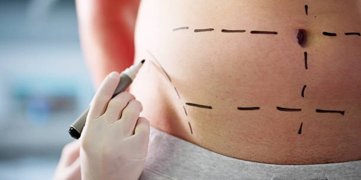 Liposuction in Riyadh: Understanding the Recovery Timeline
