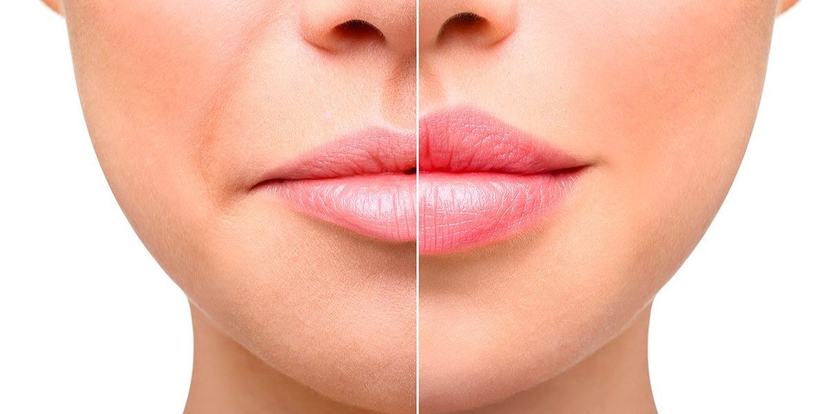 Pain Management During Lip Augmentation