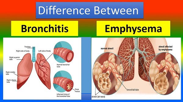 Bronchiectasis vs Emphysema Explained — Which One Damages Your Lungs More? - Herbal Care Products - Blog