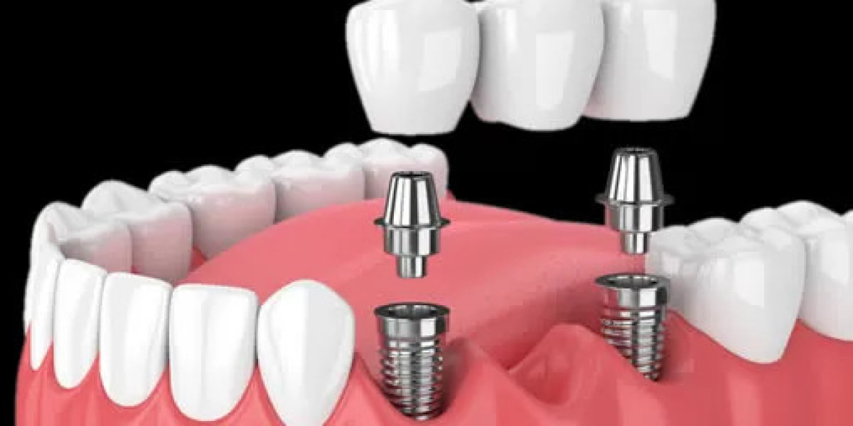 Exploring Ceramic Dental Implants for a Natural Look