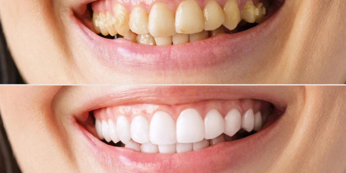 Teeth Whitening Secrets to Unlock Maximum Confidence Every Day