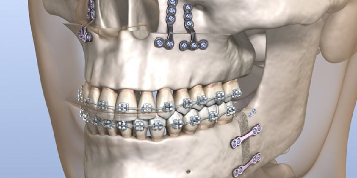 Cost Factors Affecting Jaw Surgery in Islamabad