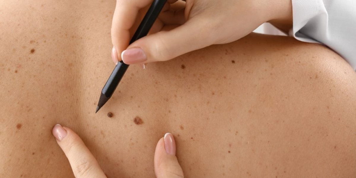 Chemical Skin Wart Removal Cost Overview