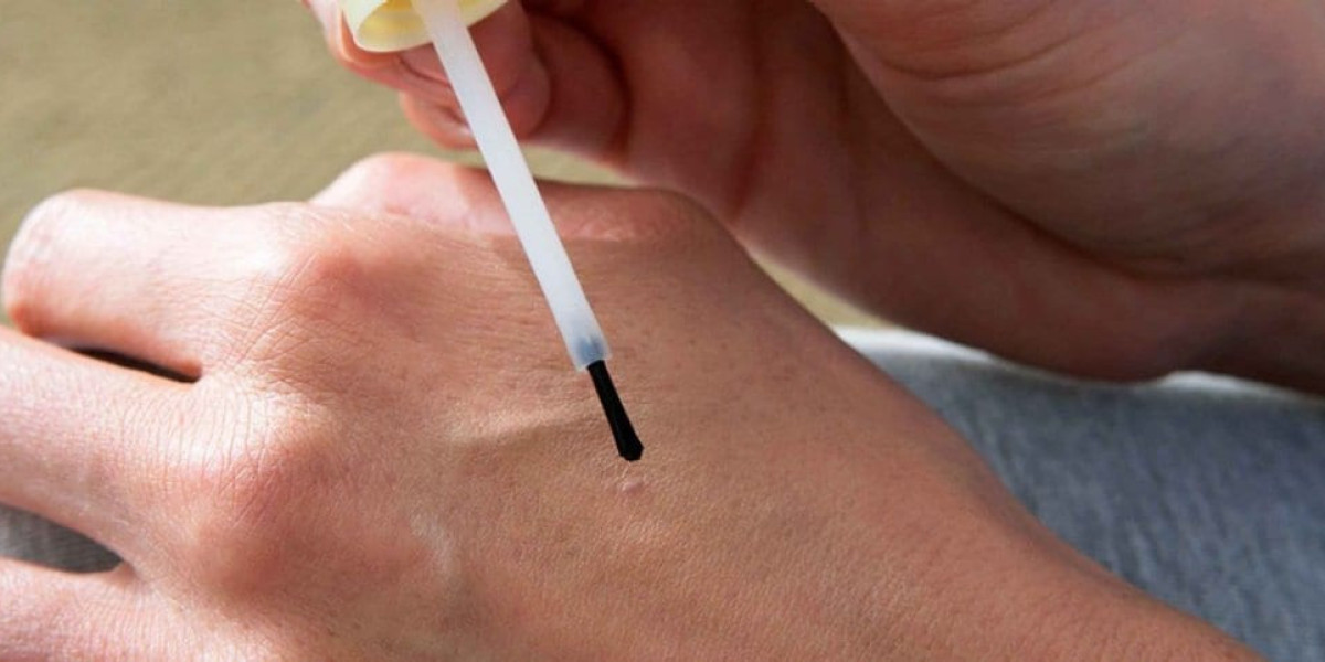 Skin Wart Removal Cost: Understanding the Treatment Process