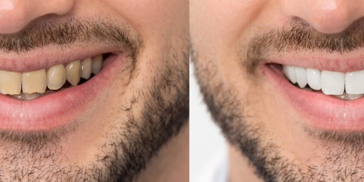 Teeth Whitening in Dubai for a Clean Fresh Look That Lasts Daily