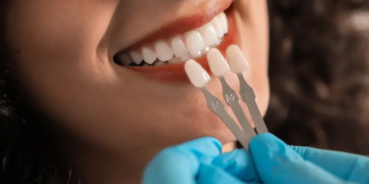 Unlock Your Dream Smile Effortlessly with Modern Dental Veneers Cost