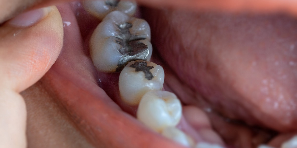 Tooth Filling Cost for Amalgam Fillings