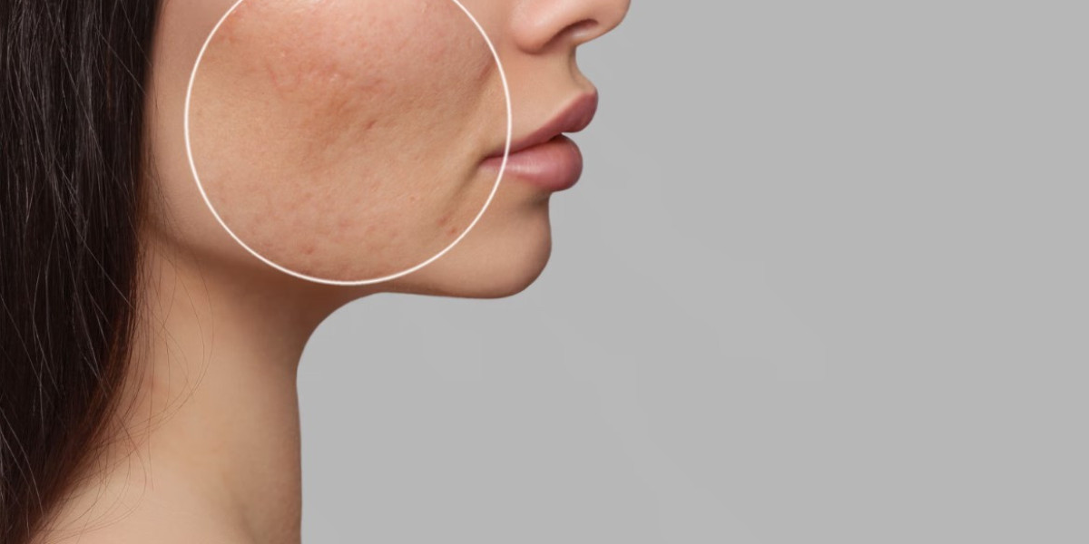 Non-Surgical Acne Scar Treatments in Islamabad