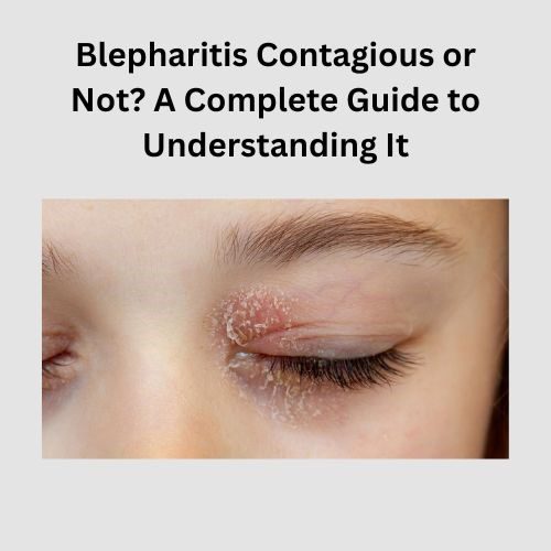 Blepharitis Contagious or Not? A Complete Guide to Understanding It - Herbal Care Products - Blog