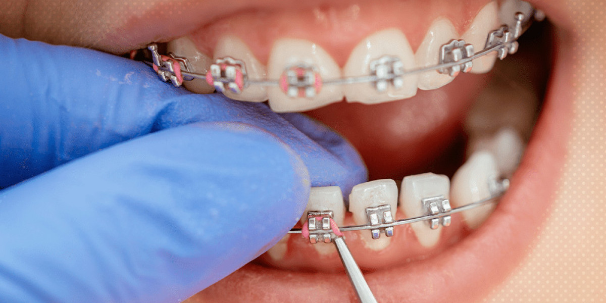 Refresh Self-Confidence Through Transparent Teeth Braces Costs
