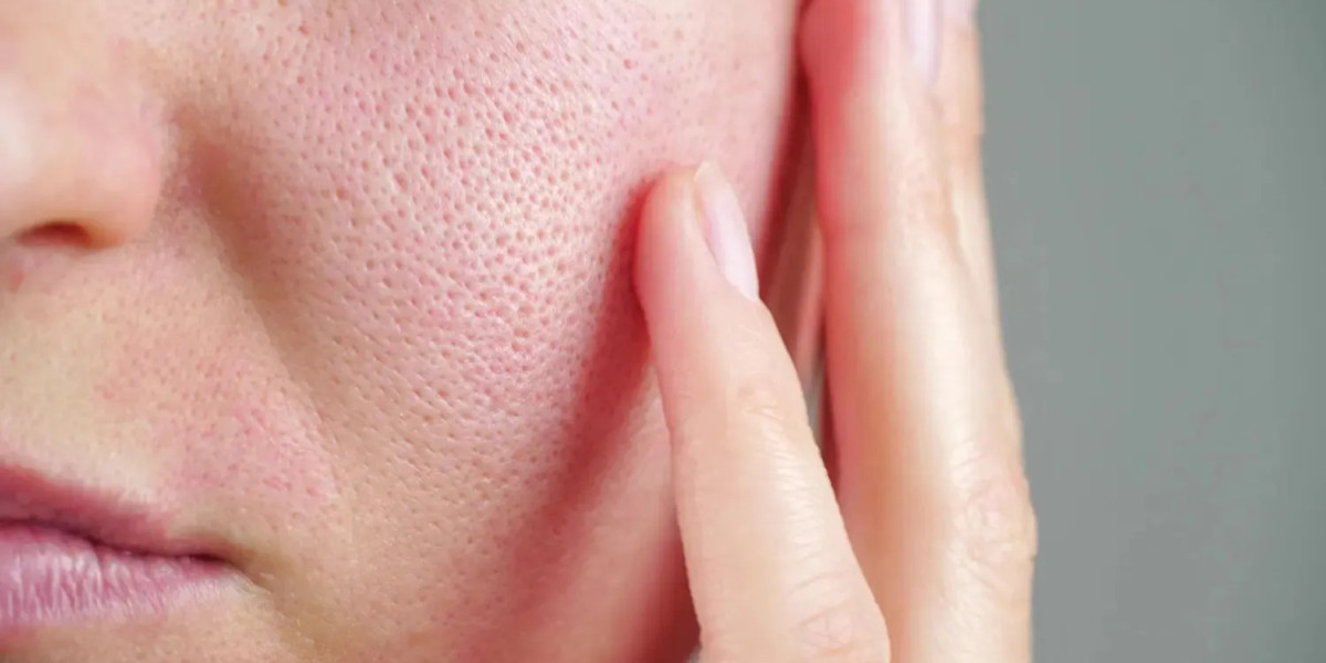 Laser Skincare Treatments for Large Pores: Are They Effective?