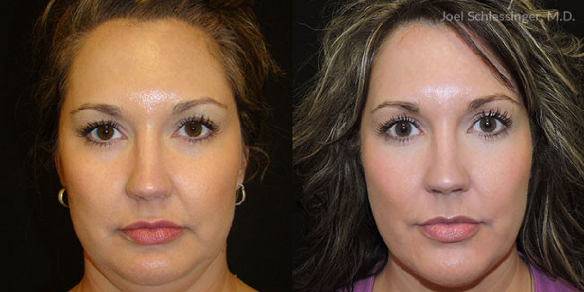 What Happens in Botox for Jawline Before and After?